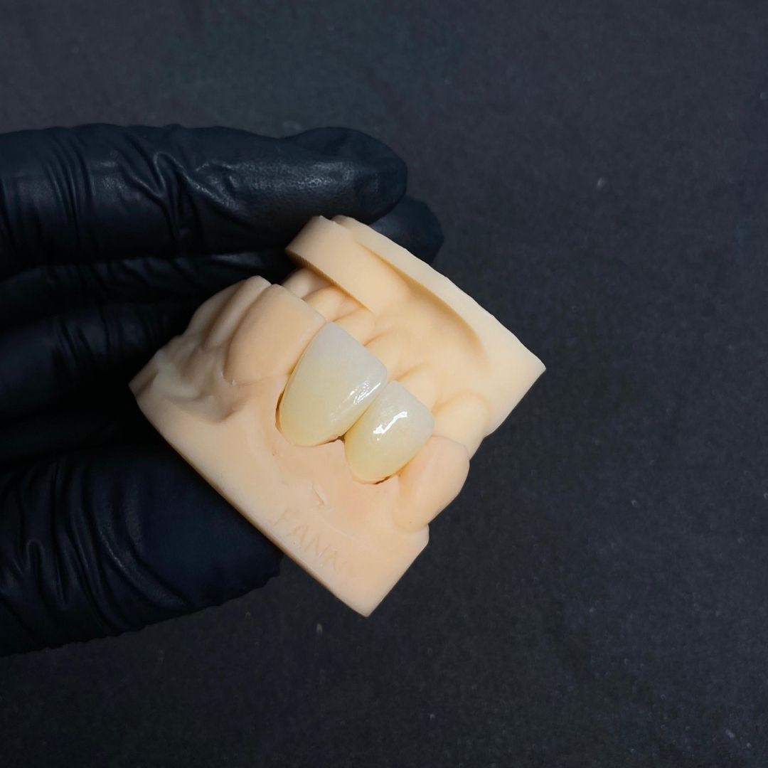 Corona en zirconio multilayer - Servidident